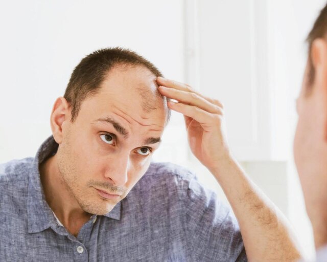 چند باور نادرست درباره ریزش مو | بازتاب امروز